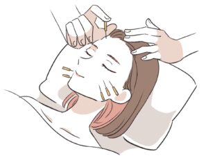 美容鍼施術風景｜肌が変わる仕組み