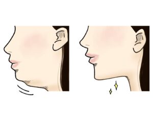 フェイスライン|肌のたるみが気になり出したら…美容鍼という選択肢も