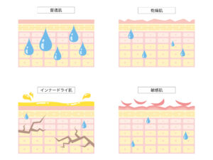 肌の説明｜乾燥肌・インナードライに悩む方に｜美容鍼でできること